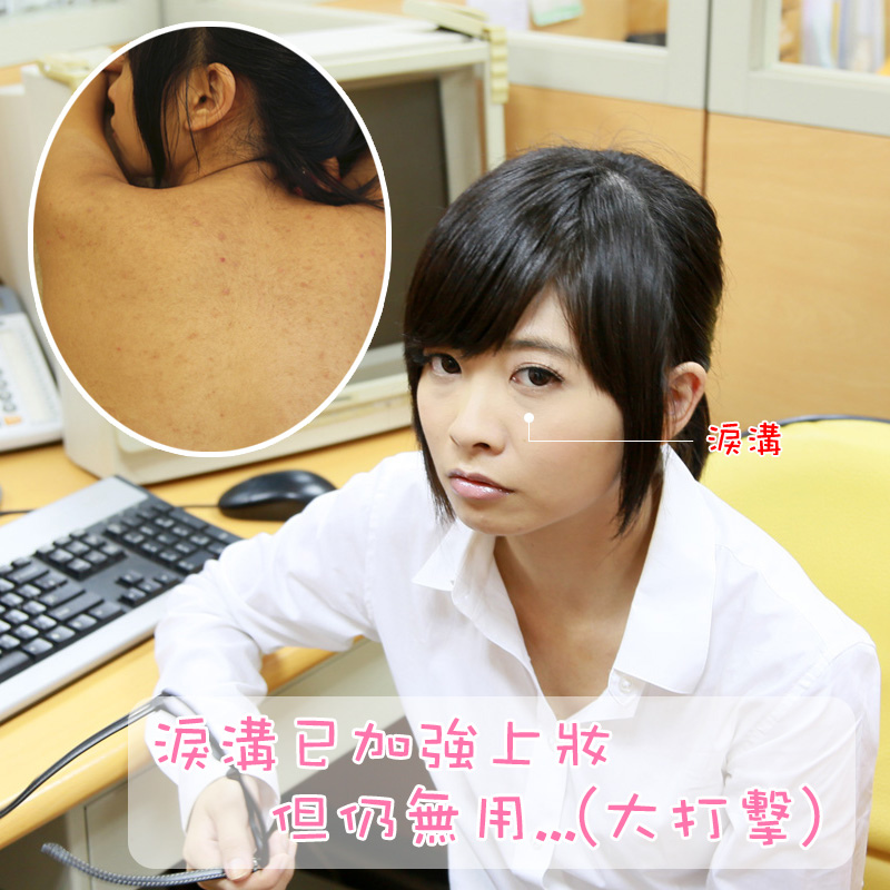 醫學美容 楊氏羅丹 黑眼圈 淚溝